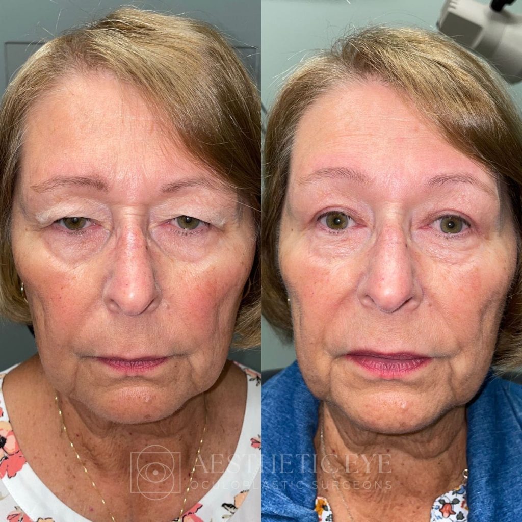 Before & After UpperBleph PtosisRepair
