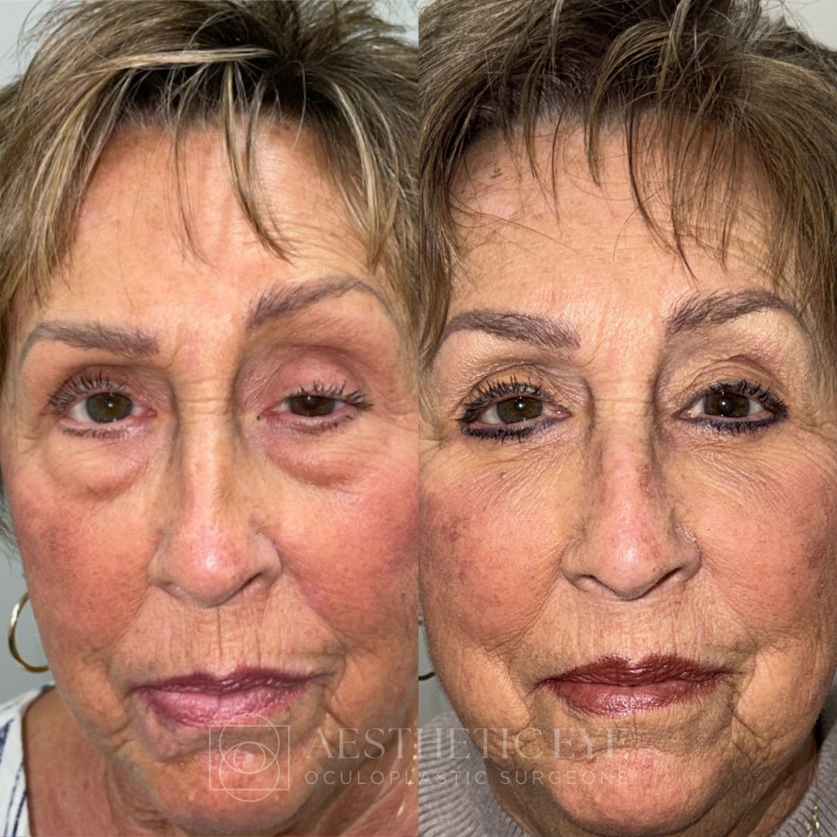 Left Upper Lid Ptosis and Cosmetic Bilateral Lower Eyelid Blepharoplasty before and after