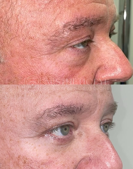 Upper Blepharoplasty-Lower Blepharoplasty-Ptosis patient photo before and after