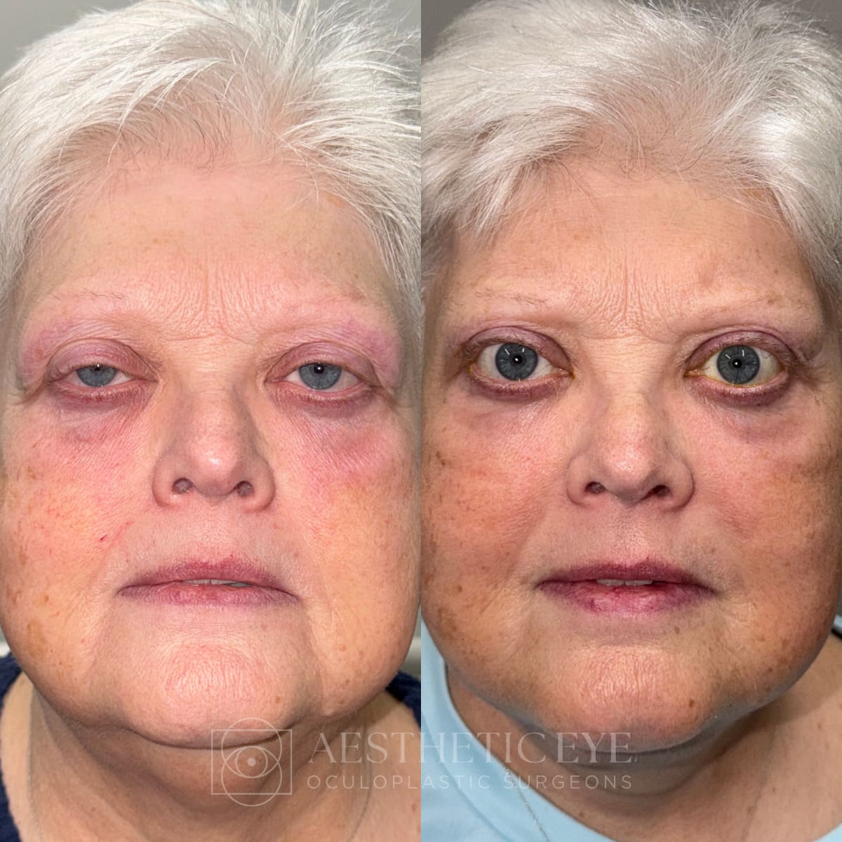 Upper Blepharoplasty, and Brow Lift before and after patient photo