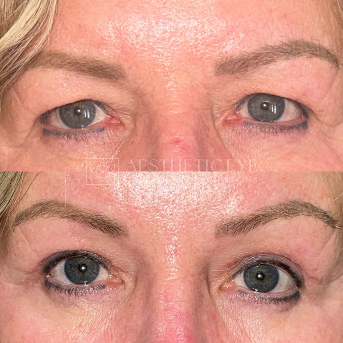 Before and after upper eyelid blepharoplasty and endoscopic brow lift