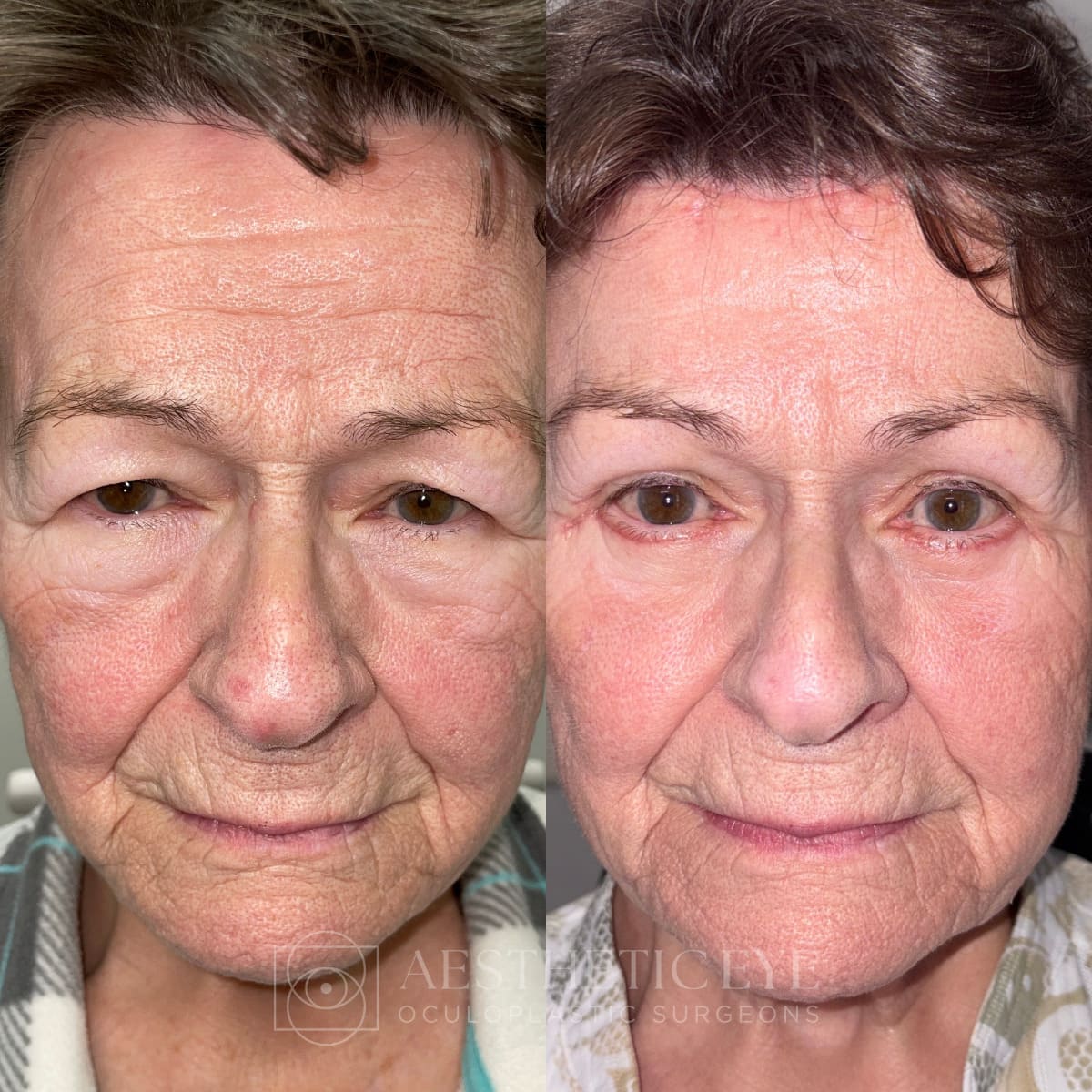 Before and after upper and lower eyelid blepharoplasty, ptosis repair, and brow lift
