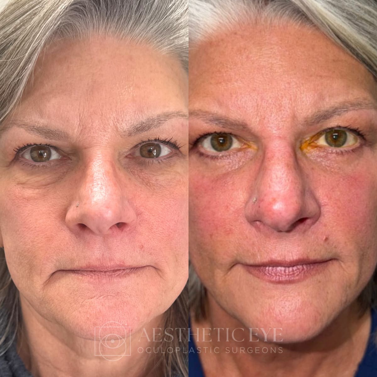 Female patient before and after lower blepharoplasty