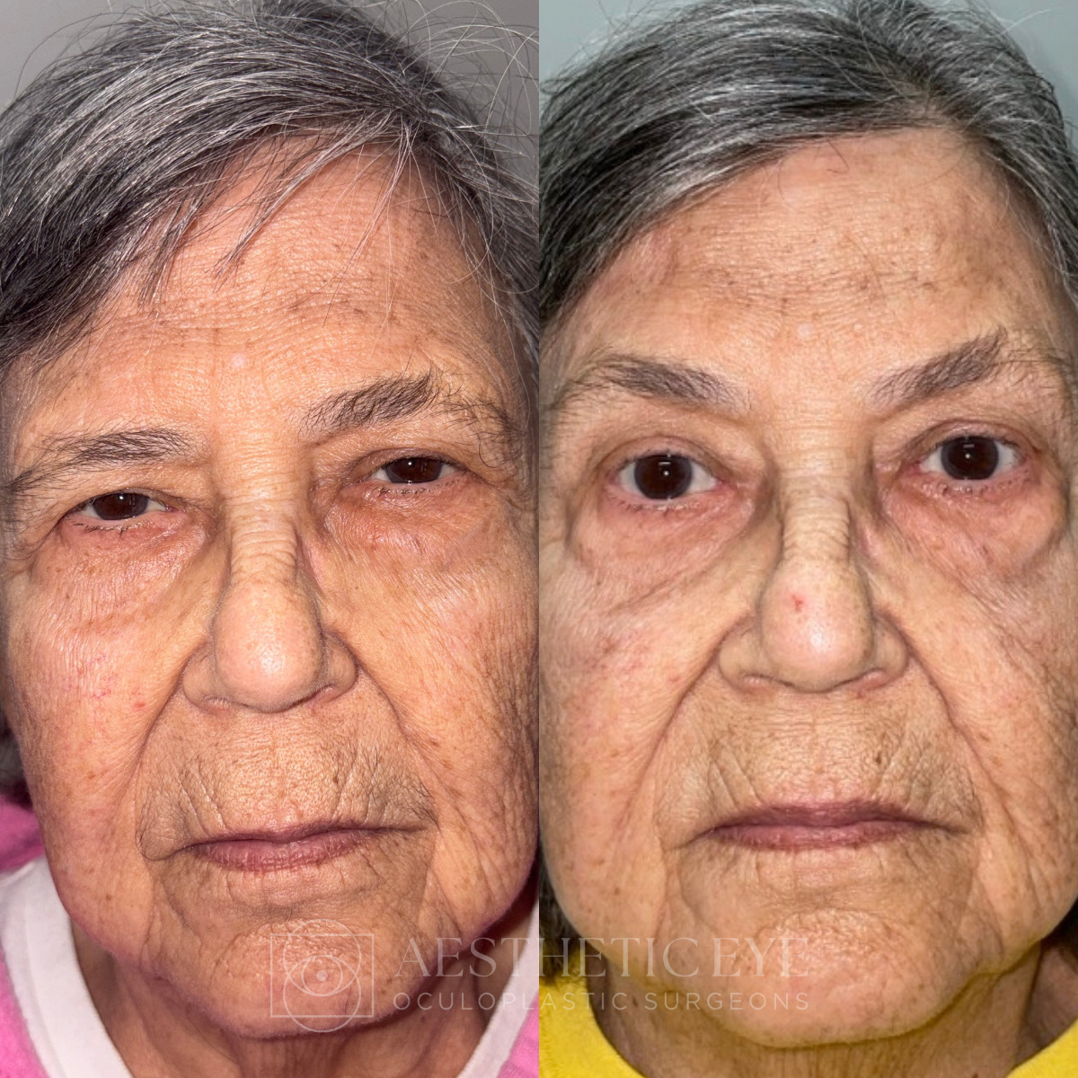 Female patient before and after browplasty