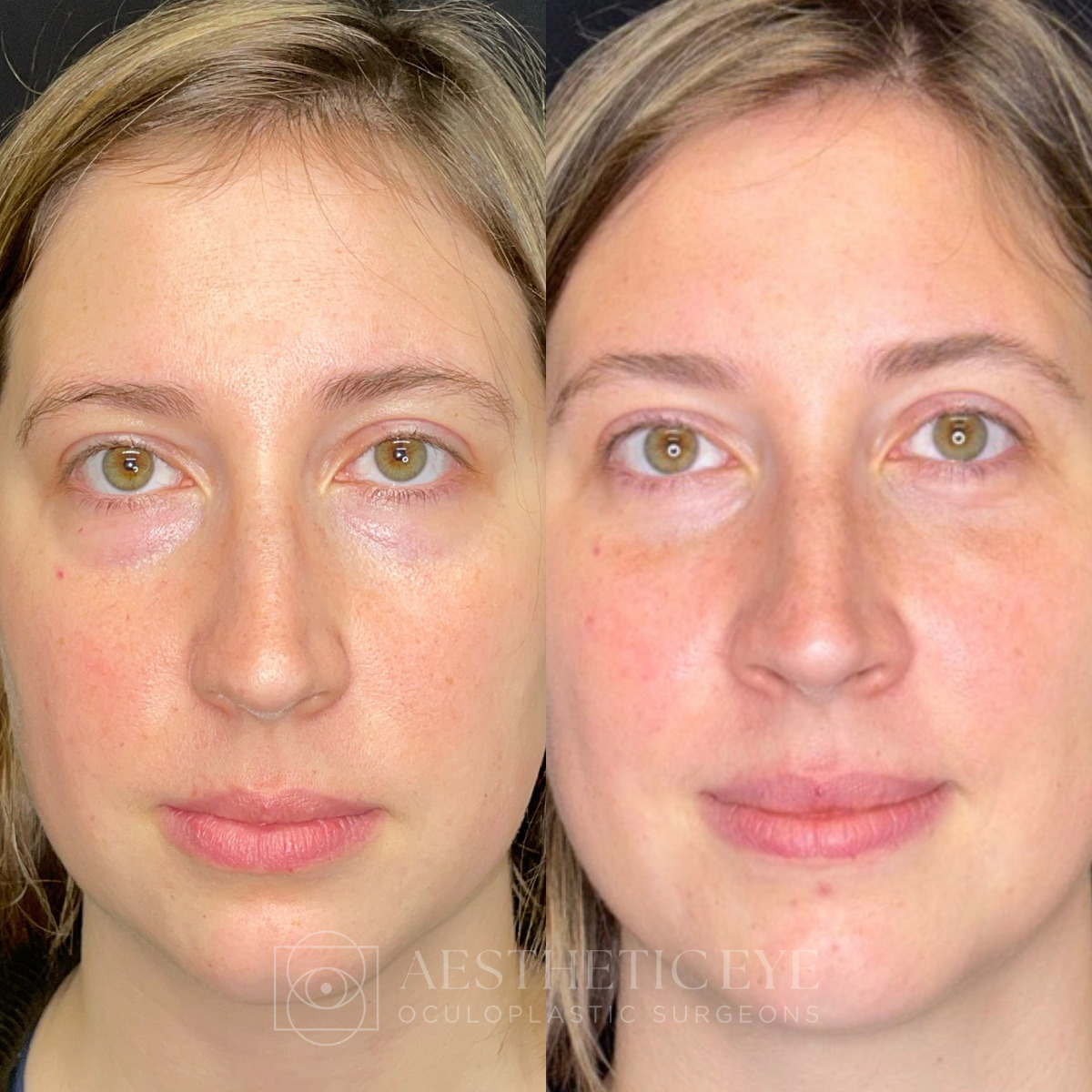 Female patient before and after lower blepharoplasty