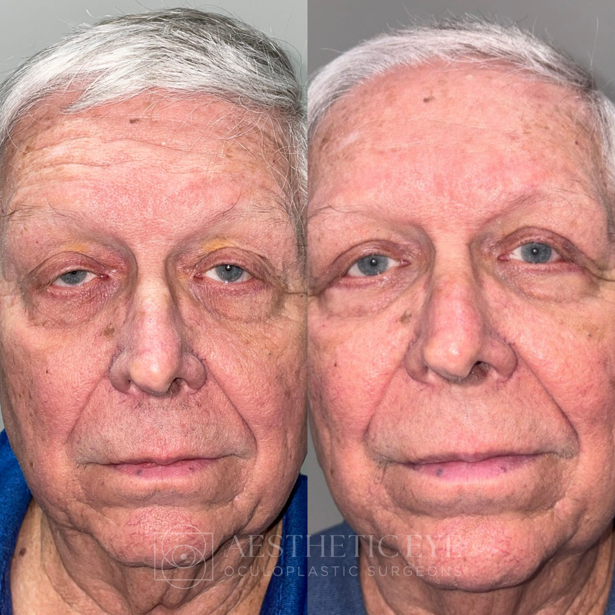 Male patient before and after upper blepharoplasty