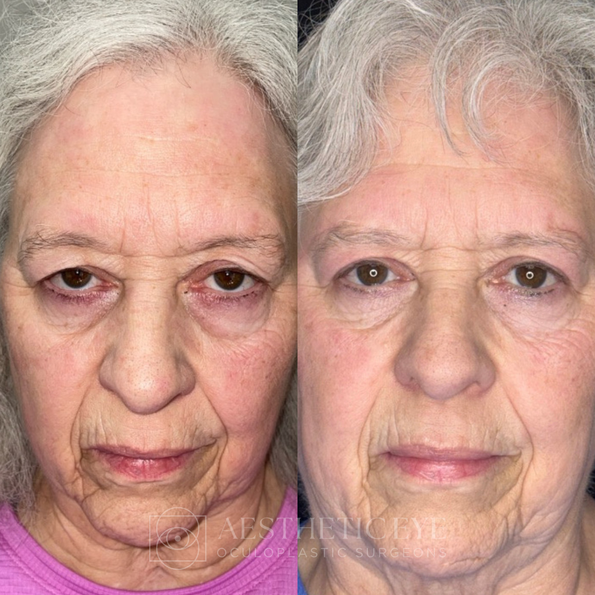 Female patient before and after upper blepharoplasty and brow lift