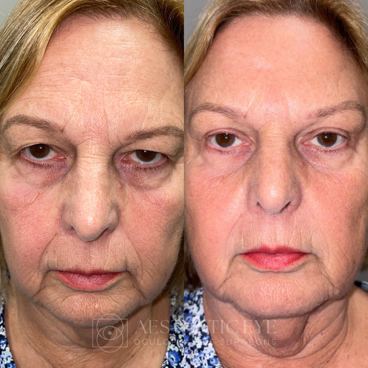 Female patient before and after upper blepharoplasty and brow lift