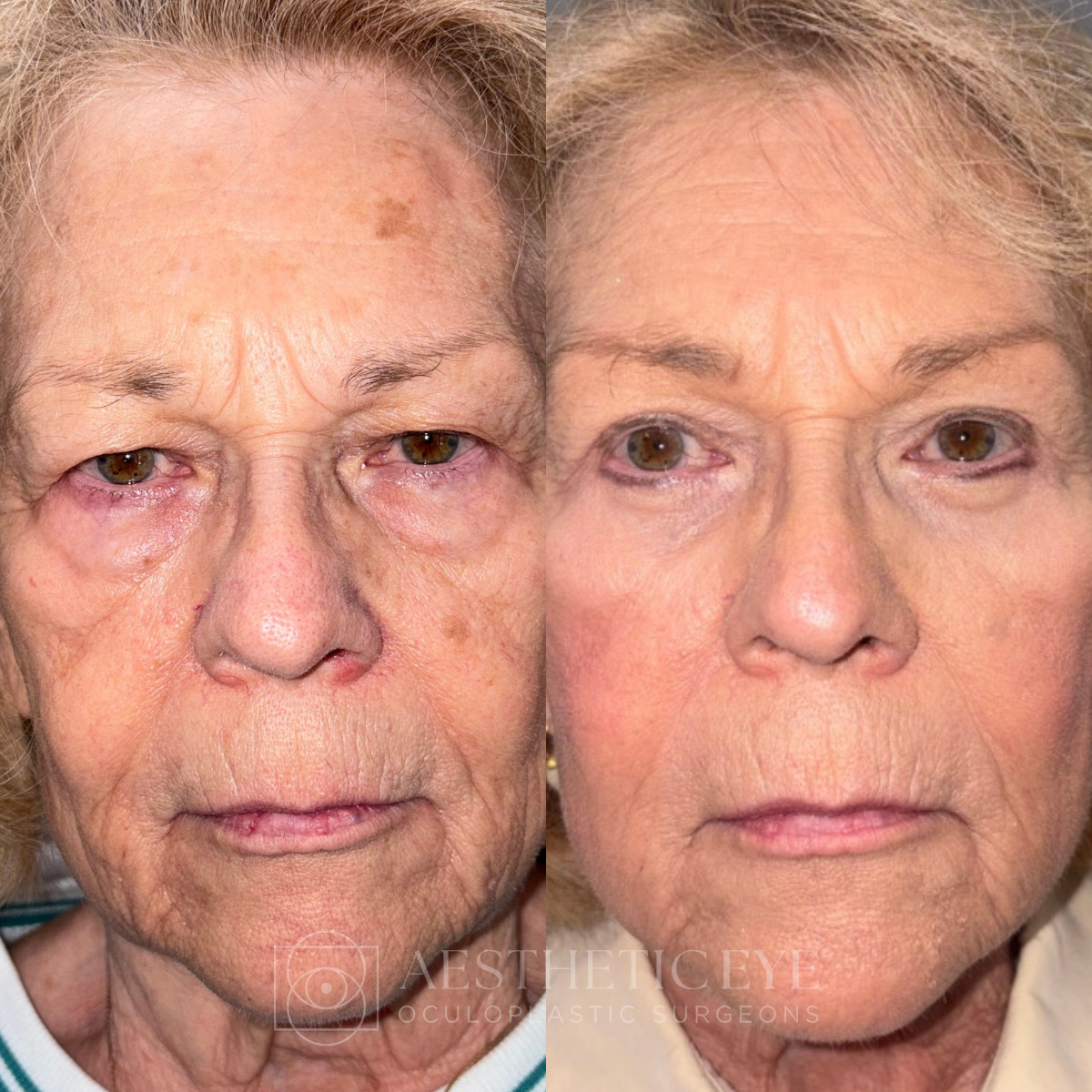 Female patient before and after upper and lower blepharoplasty